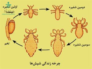 شپش سر کودکان 